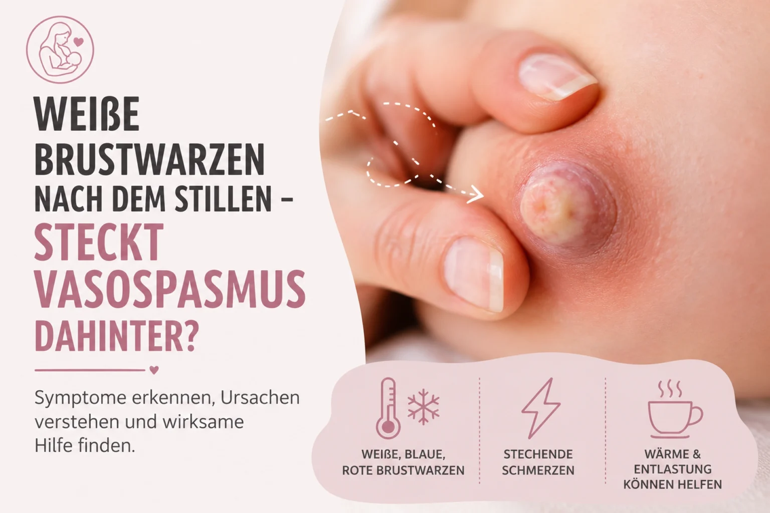 Weiße Brustwarzen nach dem Stillen – steckt Vasospasmus dahinter?