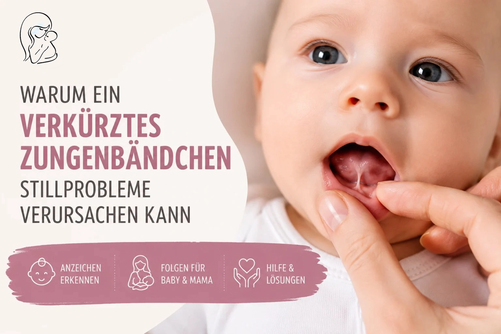 Warum ein verkürztes Zungenbändchen Stillprobleme verursachen kann