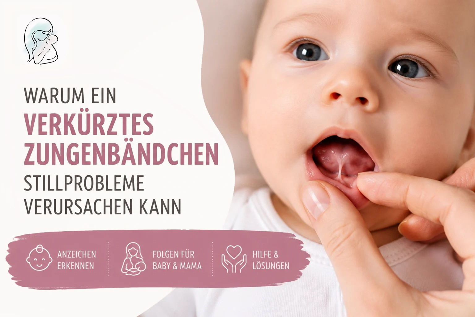 Warum ein verkürztes Zungenbändchen Stillprobleme verursachen kann