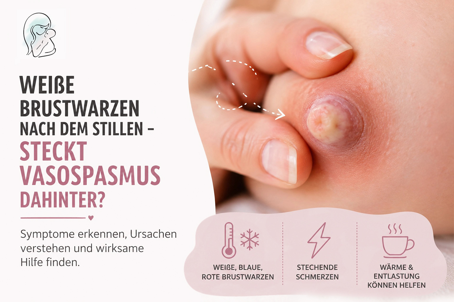 Weiße Brustwarzen nach dem Stillen – steckt Vasospasmus dahinter?