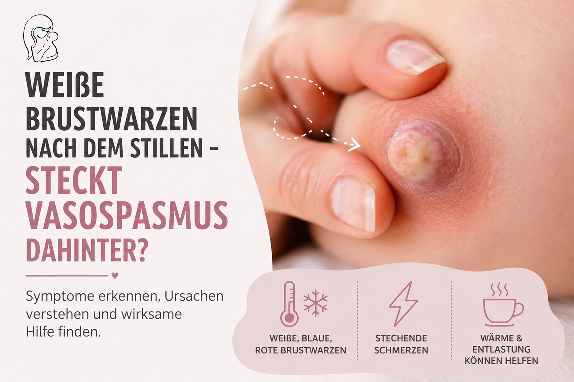 Weiße Brustwarzen nach dem Stillen – steckt Vasospasmus dahinter?